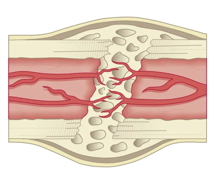Framed Print : Cross section biomedical illustration of bone repairing itself with new, soft, spongy callus developing on framework provided by fibrous tissue, joining the broken ends Framed Print : Cross section biomedical illustration of bone repairing itself with new, soft, spongy callus developing on framework provided by fibrous tissue, joining the broken ends