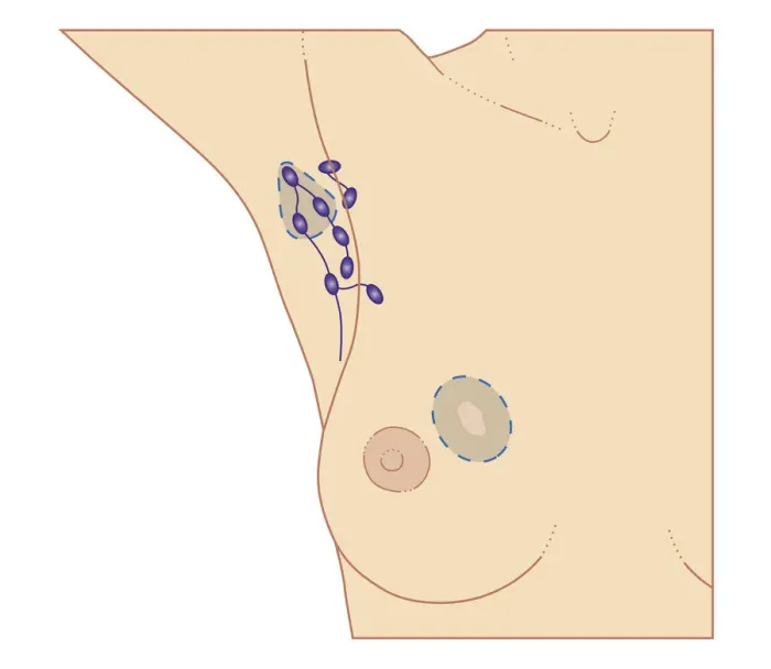Framed Print : Cross section biomedical illustration of breast cancer tumour and lymph nodes requiring lumpectomy procedure Framed Print : Cross section biomedical illustration of breast cancer tumour and lymph nodes requiring lumpectomy procedure