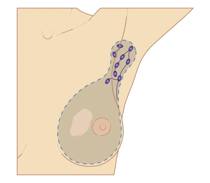 Framed Print : Cross section biomedical illustration of breast cancer tumour and lymph nodes requiring mastectomy procedure Framed Print : Cross section biomedical illustration of breast cancer tumour and lymph nodes requiring mastectomy procedure