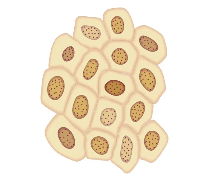 Framed Print : Cross section biomedical illustration of cancer cells forming tumour at fourth doubling stage Framed Print : Cross section biomedical illustration of cancer cells forming tumour at fourth doubling stage