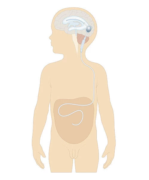 Cross section biomedical illustration of cerebral shunt with valve inserted in brain of boy to remove excess cerebrospinal fluid with tube to carry into stomach