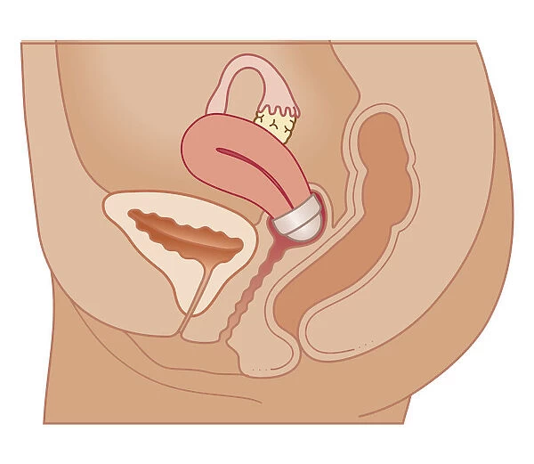 Cross section biomedical illustration of cervical cap in position