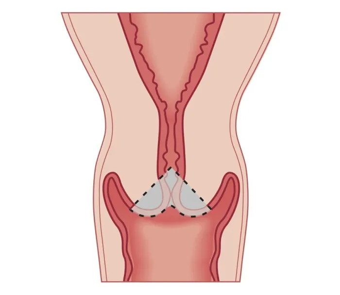 Framed Print : Cross section biomedical illustration of Cervical conization biopsy of cervical intraepithelial neoplasia Framed Print : Cross section biomedical illustration of Cervical conization biopsy of cervical intraepithelial neoplasia