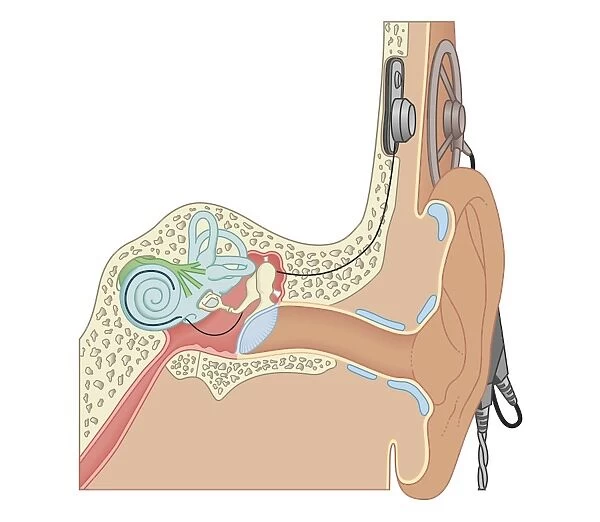 Cross section biomedical illustration of cochlear implants