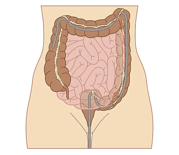 Cross section biomedical illustration of colonoscopy procedure in adult female