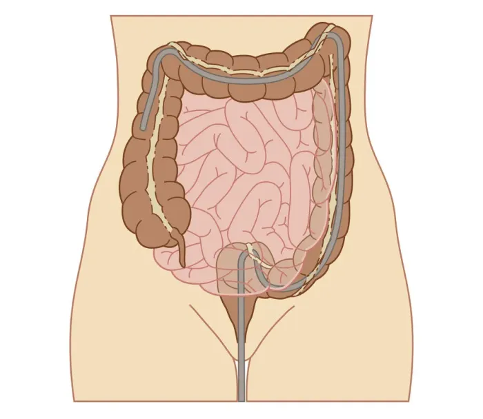 Framed Print : Cross section biomedical illustration of colonoscopy procedure in adult female Framed Print : Cross section biomedical illustration of colonoscopy procedure in adult female
