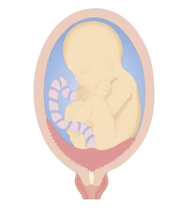 Framed Print : Cross section biomedical illustration of complete placenta praevia Framed Print : Cross section biomedical illustration of complete placenta praevia