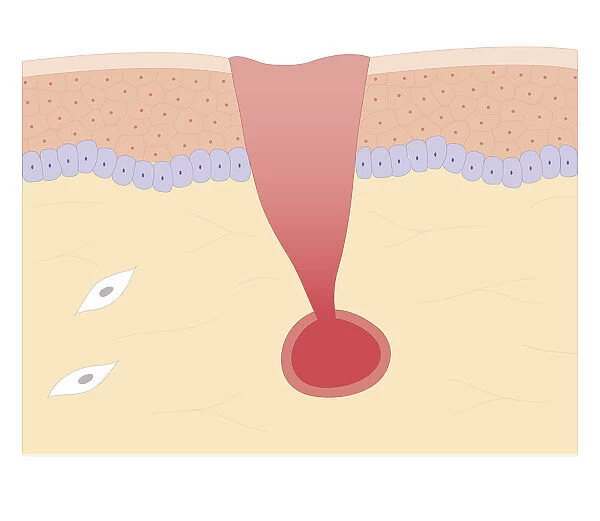 Cross section biomedical illustration of damaged skin and blood vessel