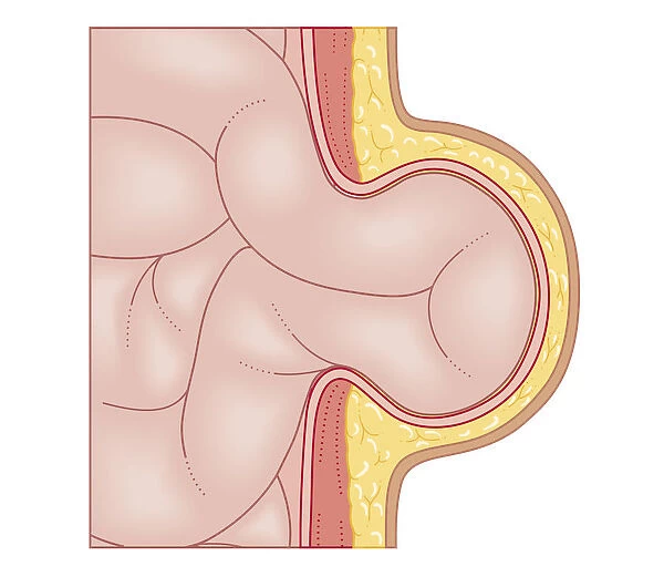 Cross section biomedical illustration of development of hernia