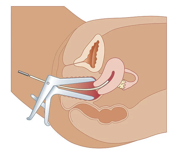 Cross section biomedical illustration of endometrial biopsy using Novak curette