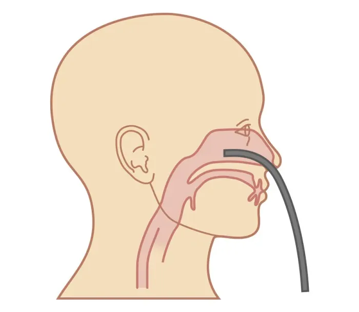 Framed Print : Cross section biomedical illustration of endoscope inserted through nose for Anterior Rhinoscopy procedure Framed Print : Cross section biomedical illustration of endoscope inserted through nose for Anterior Rhinoscopy procedure