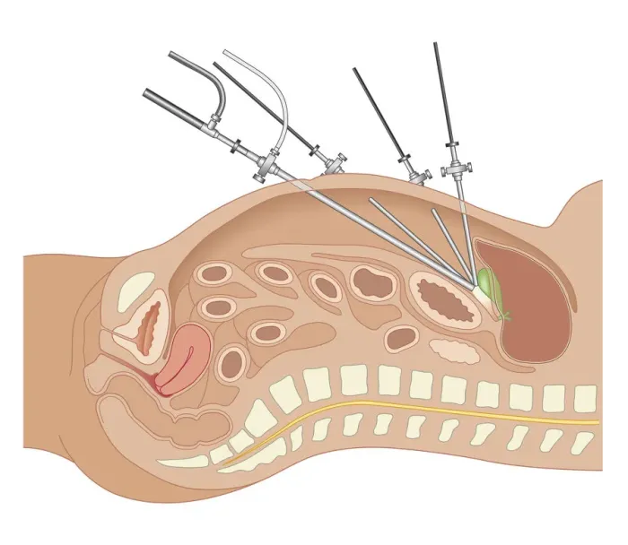 Framed Print : Cross section biomedical illustration of endoscope and tubes inserted in abdomen of adult female during Laparoscopic Surgery
