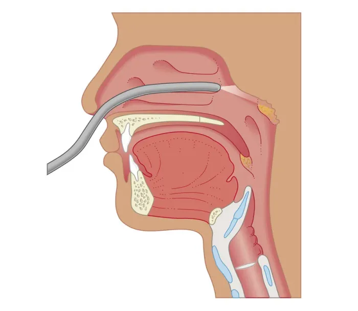 Framed Print : Cross section biomedical illustration of endoscopy of the nose and throat Framed Print : Cross section biomedical illustration of endoscopy of the nose and throat