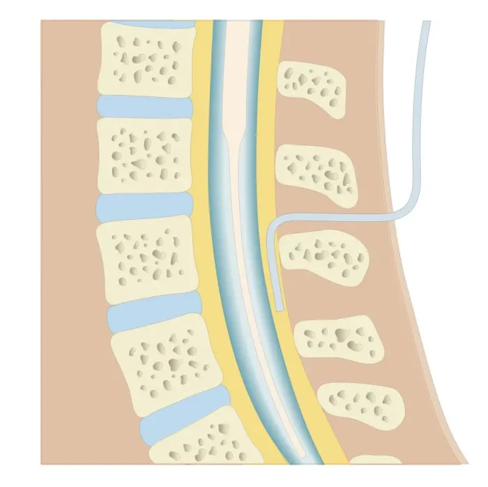 Framed Print : Cross section biomedical illustration of epidural anaesthesia during labour Framed Print : Cross section biomedical illustration of epidural anaesthesia during labour