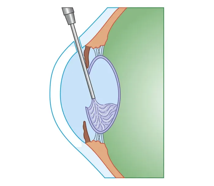 Framed Print : Cross section biomedical illustration of eye cataract surgery sucking softened tissue out using ultrasound probe inserted into lens via incision in cornea