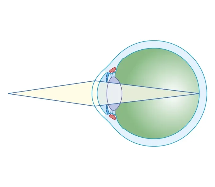 Framed Print : Cross section biomedical illustration of eye focusing on near object Framed Print : Cross section biomedical illustration of eye focusing on near object
