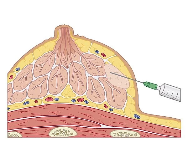Cross section biomedical illustration of fine needle aspiration of breast lump