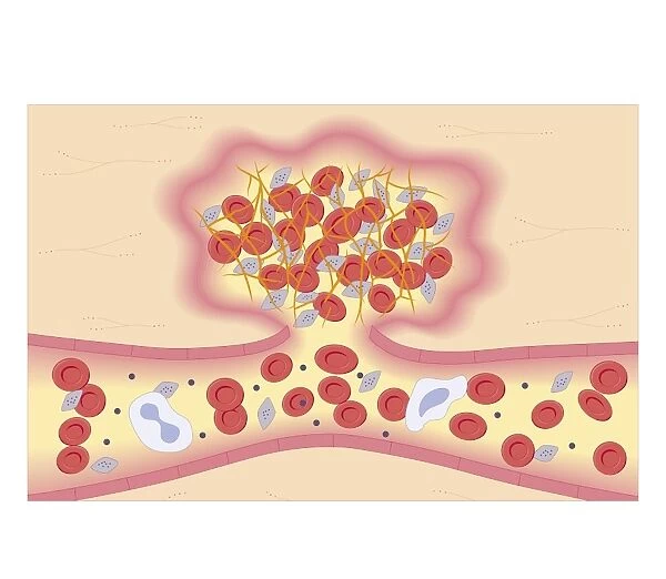 Cross section biomedical illustration of formation of blood clot by protein fibrogen converting into insoluble fibrin strands