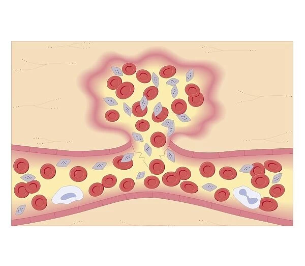 Cross section biomedical illustration of formation of blood clot with damaged blood vessel constricting and platelets are activated and adhere to the blood vessel wall