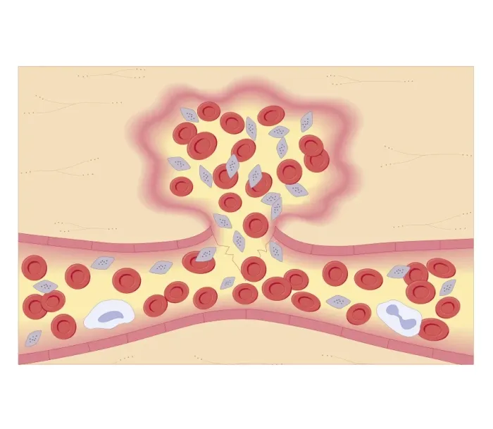 Framed Print : Cross section biomedical illustration of formation of blood clot with damaged blood vessel constricting and platelets are activated and adhere to the blood vessel wall Framed Print : Cross section biomedical illustration of formation of blood clot with damaged blood vessel constricting and platelets are activated and adhere to the blood vessel wall