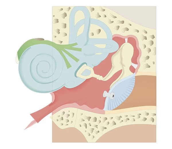 Cross section biomedical illustration of grommet inserted in eardrum (tympanic membrane)