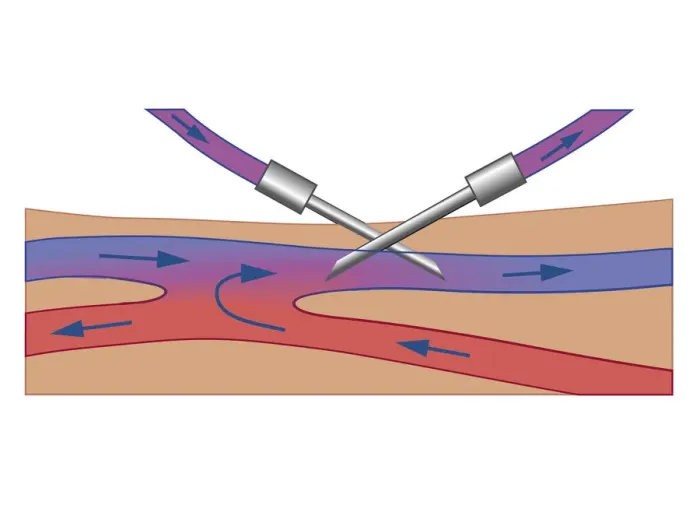 Framed Print : Cross section biomedical illustration of Haemodialysis showing needle inserted into vein and dialysate flowing in opposite direction to blood flow