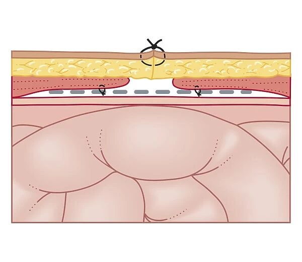 Cross section biomedical illustration of hernia repair using synthetic mesh
