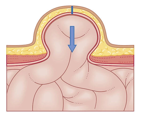 Cross section biomedical illustration of hernia repair and site of incision to uncover the hernia