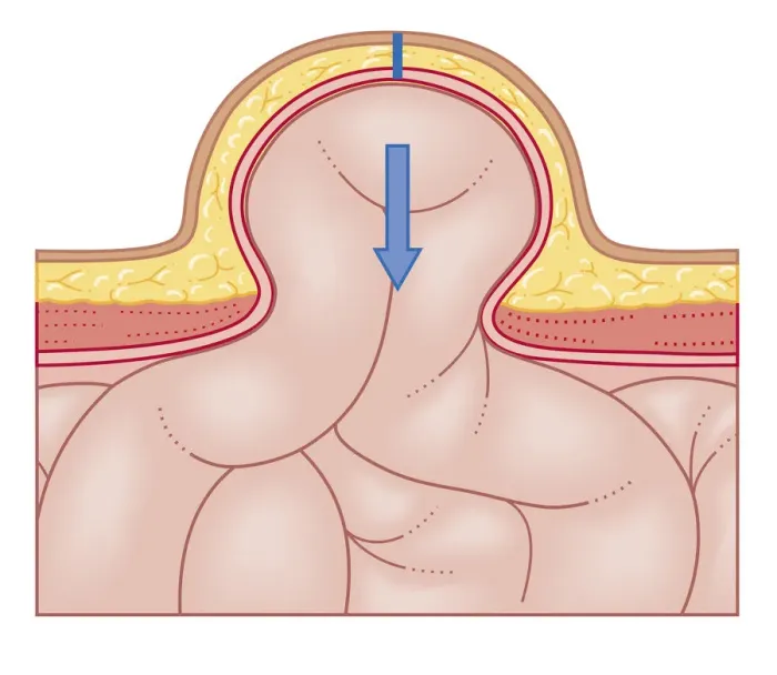 Framed Print : Cross section biomedical illustration of hernia repair and site of incision to uncover the hernia Framed Print : Cross section biomedical illustration of hernia repair and site of incision to uncover the hernia
