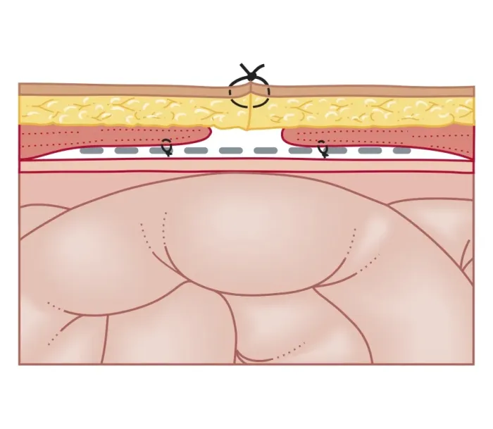 Framed Print : Cross section biomedical illustration of hernia repair using synthetic mesh Framed Print : Cross section biomedical illustration of hernia repair using synthetic mesh