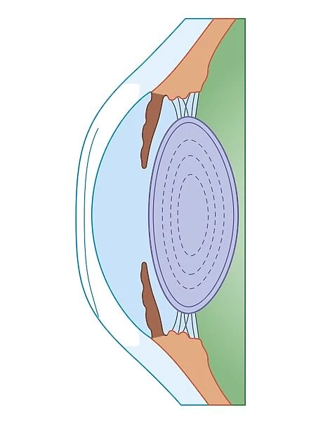 Cross section biomedical illustration of human eye before corrective surgery for myopia