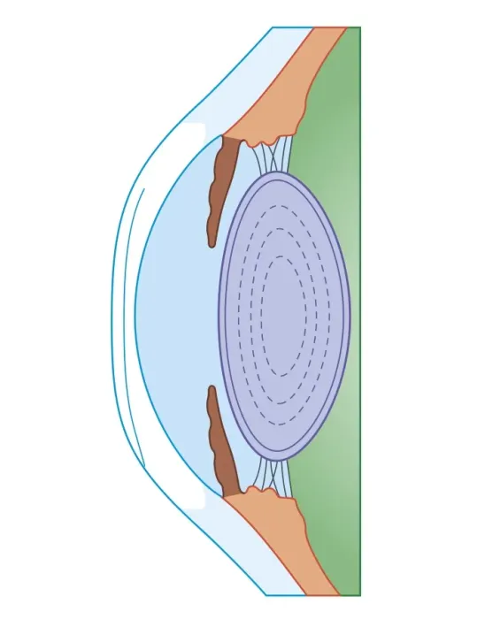 Framed Print : Cross section biomedical illustration of human eye before corrective surgery for myopia Framed Print : Cross section biomedical illustration of human eye before corrective surgery for myopia