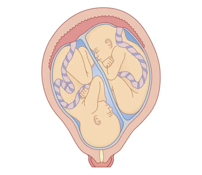Framed Print : Cross section biomedical illustration of identical twins in uterus sharing placenta Framed Print : Cross section biomedical illustration of identical twins in uterus sharing placenta