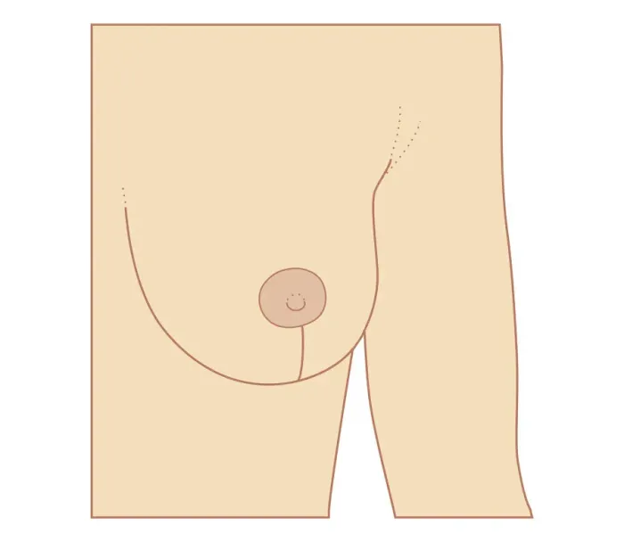 Framed Print : Cross section biomedical illustration of incision site for breast reduction procedure Framed Print : Cross section biomedical illustration of incision site for breast reduction procedure