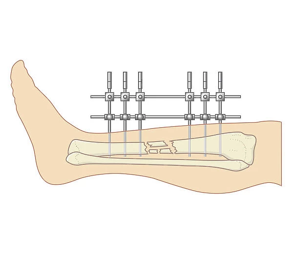 Cross section biomedical illustration of internal position external fixator used to repair broken leg