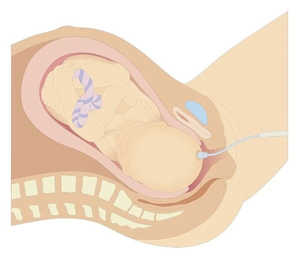 Cross section biomedical illustration of internal foetal monitoring prior to birth