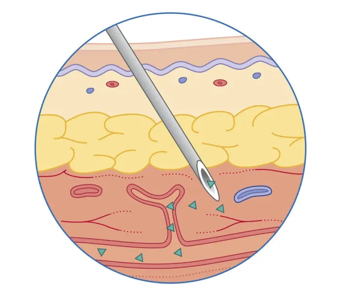 Framed Print : Cross section biomedical illustration of intramuscular drug injected into muscle dispersing into bloodstream Framed Print : Cross section biomedical illustration of intramuscular drug injected into muscle dispersing into bloodstream