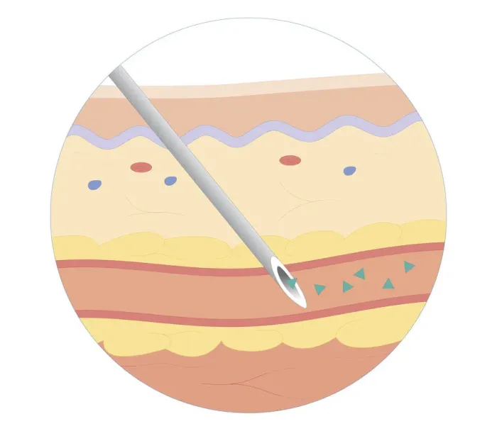 Framed Print : Cross section biomedical illustration of intravenous route of drugs injected into blood vessel for rapidly circulation