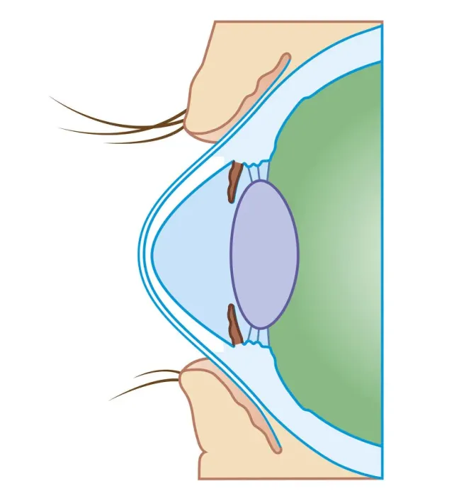 Framed Print : Cross section biomedical illustration of keratoconus or conical cornea Framed Print : Cross section biomedical illustration of keratoconus or conical cornea