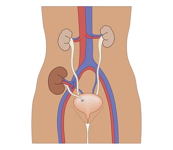 Cross section biomedical illustration of kidney transplant