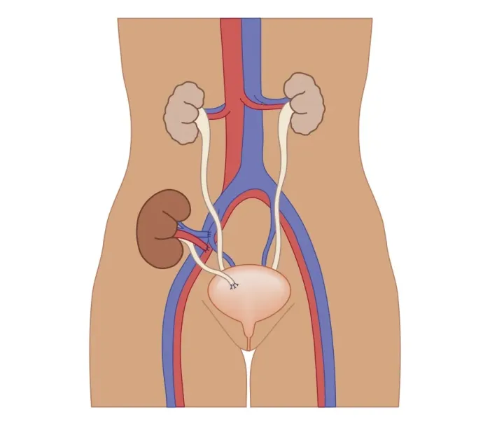Framed Print : Cross section biomedical illustration of kidney transplant