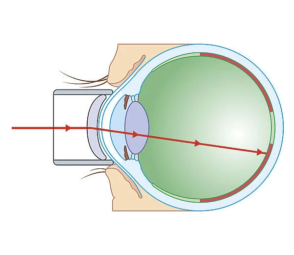 Cross section biomedical illustration of laser surgery for retinopathy