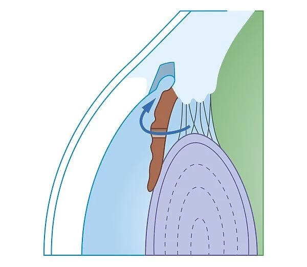 Cross section biomedical illustration of laser iridectomy treatment technique for acute glaucoma