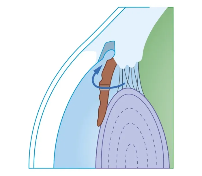 Framed Print : Cross section biomedical illustration of laser iridectomy treatment technique for acute glaucoma Framed Print : Cross section biomedical illustration of laser iridectomy treatment technique for acute glaucoma