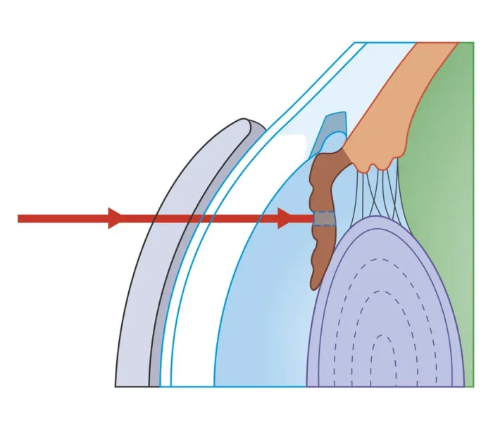 Framed Print : Cross section biomedical illustration of laser iridotomy where laser beam is focused on iris through thick contact lens to cut hole in iris