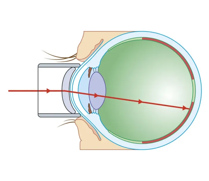 Framed Print : Cross section biomedical illustration of laser surgery for retinopathy Framed Print : Cross section biomedical illustration of laser surgery for retinopathy