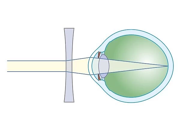 Cross section biomedical illustration of lens to correct myopia