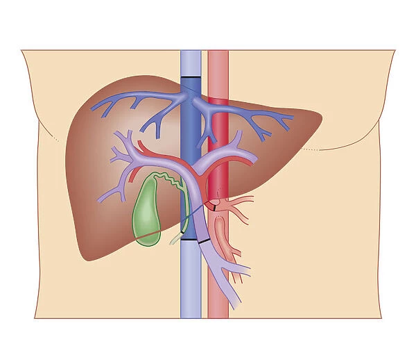 Cross section biomedical illustration of liver transplant procedure