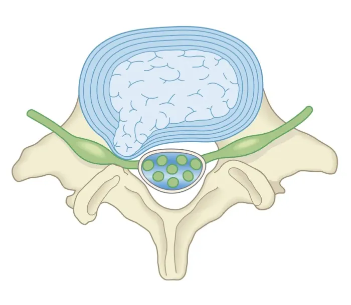 Framed Print : Cross section biomedical illustration of lumber microdisectomy before surgery