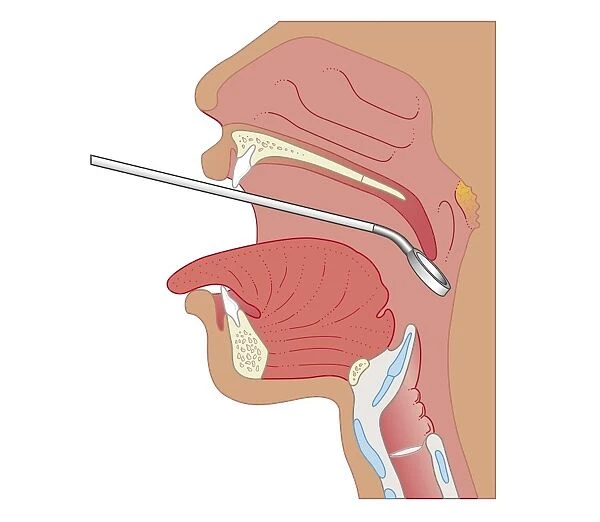 Cross section biomedical illustration of mirror laryngoscopy